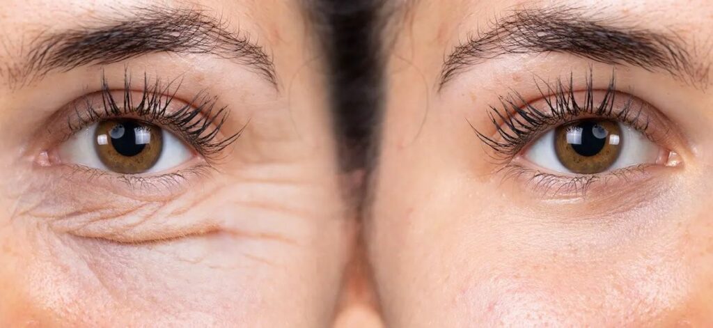 درمان سیاهی و گودی زیر چشم با مزوتراپی