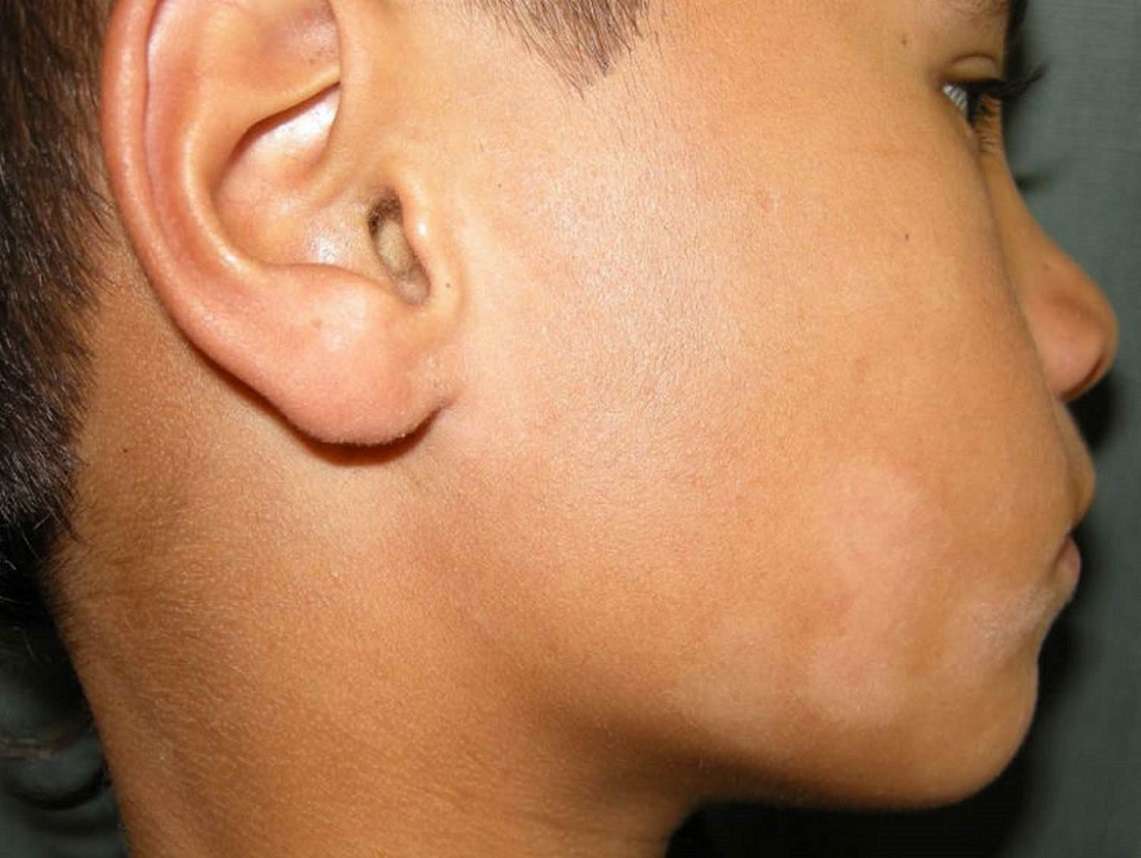 لکه های پوستی ناشی از پیتریازیس آلبا