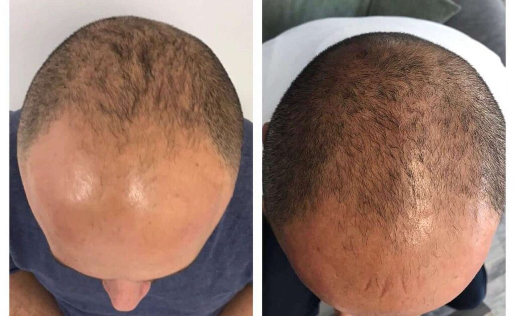 عکس قبل و بعد از کربوکسی تراپی برای درمان ریزش مو