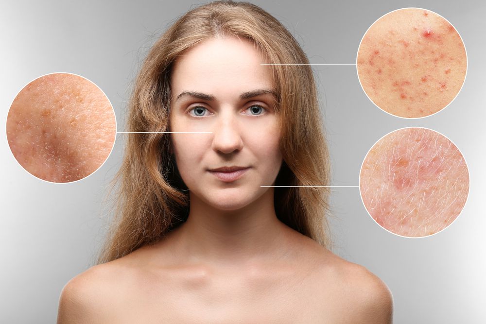 علل و محرک های روزاسه خفیف