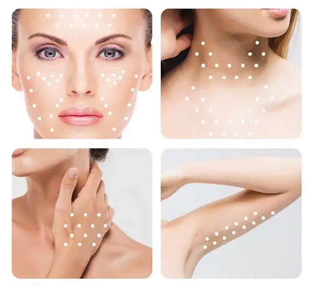 نقاط تزریق مزوتراپی