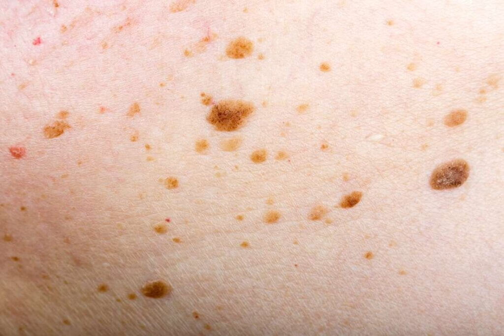 محرک کراتوز سبورئیک چیست