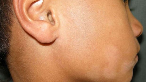 لکه های پوستی ناشی از پیتریازیس آلبا